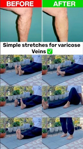 Varicose Veins Relief at Home | 5 Min Daily Stretches for Better Blood Flow