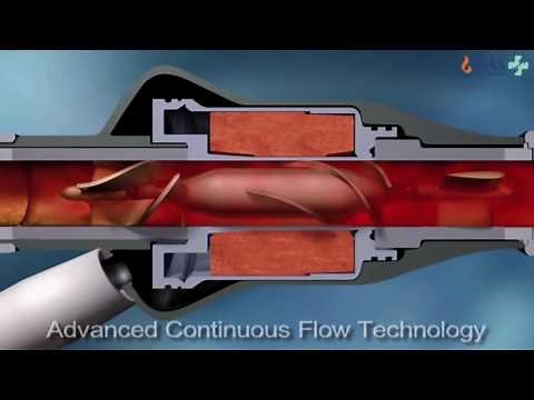 LVAD Procedure | Left Ventricular Assist Device | Heart Failure Treatment - Max Hospital