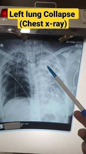 Left lung collapse(left fibro- bronchiectasis)# chest x ray