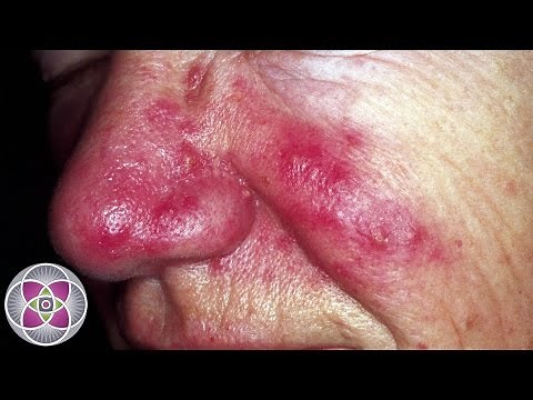 Laser Treatment for Rosacea & Skin Redness