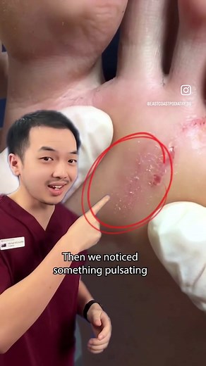 Foot Parasites: Worm Infection and Treatment