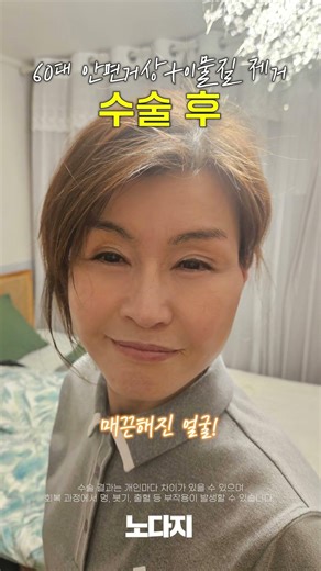 Success Story of a Facelift Revision That Overcame Lifting Side Effects!
