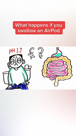Dangers of Swallowing AirPods: What Happens If You Swallow Ear Buds