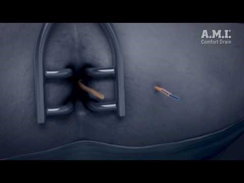 Comfort Drain Anorectal Fistula Long-Term Draining System