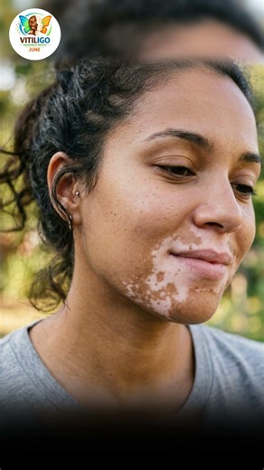 Does Vitiligo Get Worse Before It Gets Better? | Vitiligo Awareness Month June #vitiligo
