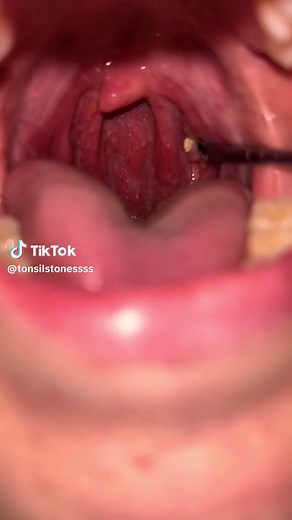 Understanding Tonsil Stones and Tonsillitis