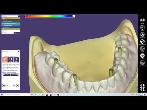 Diseño Barras / Bar module EXOCAD ( PARTE 1 )