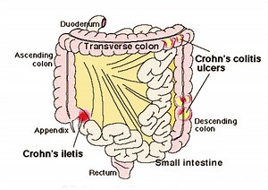 Terminal Ileitis - Treatment, Symptoms, Causes, Pictures