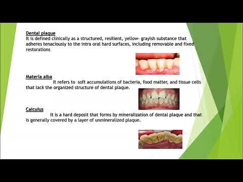 Dental plaque Vs Materia alba Vs Calculus