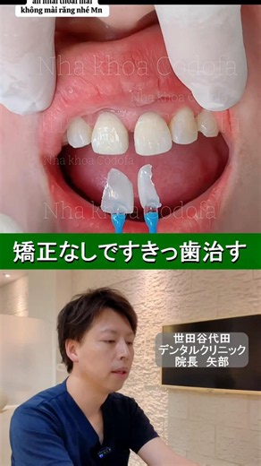 Closing the gaps in my front teeth without braces★#gappedteeth #frontteethgaps #teethalignment #o...