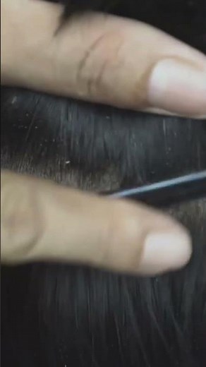 Quick and Easy Removing Scratching Big Dandruff Flakes