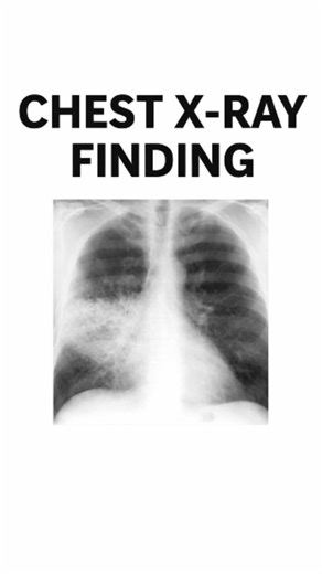 x ray tech on Instagram: "Chest X-ray Finding Explained 🫁 Understanding radiological signs helps in accurate localization of thoracic pathology. 📚 Simple explanation | Medical learning | Radiology basics Save & share for revision. Disclaimer: This post is for educational purposes only. It is not intended to diagnose or replace professional medical advice. #chestxray #radiology #xrayfinding #radiologystudent #medicaleducation radiologylife medicoChest X-ray finding Radiology basics X-ray interp