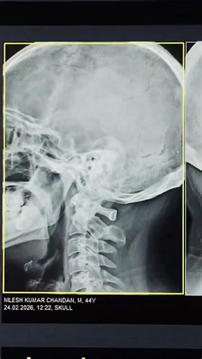 X-ray Mastoid view 🔥🔥