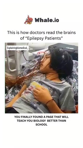 Medical on Instagram: "This type of test is called an EEG, or Electroencephalography. Doctors use this tool to read the brain’s electrical activity. The brain is full of nerve cells that communicate with each other through very tiny electrical currents. These currents can be detected without opening the head, just by using small electrodes attached to the scalp. The electrodes are connected to wires, the wires go into a machine, and the machine turns the brain’s signals into wave patterns. From 