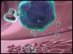 Multiple Scerosis - Interferon Beta