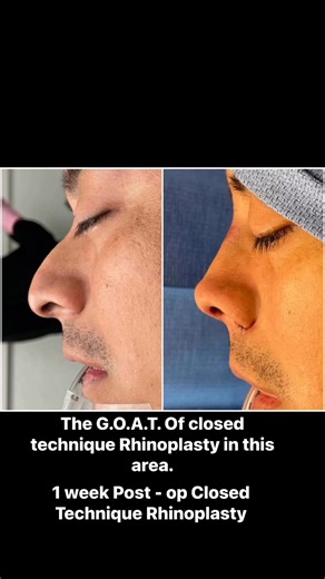 One week post-op closed technique Rhinoplasty . Most experienced at closed technique Rhinoplasty in the area . Closed means all the incisions are made inside the nose . No external incisions or scars on the outside of the nose . #larrysargent #sargentplasticsurgery #chattanoogaplasticsurgeon #chattanoogaplasticsurgery #number1bestofthebestplasticsurgerypractice2022and2023and2024and2025 #number1bestofthebestcosmeticsurgerypractice2024and2025 #aesthetics #cosmetic #nose #nosesurgery #closedtechniq