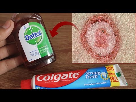 How to get rid of ringworm fast at home in Just Overnight - How to Remove Ringworm Permanently