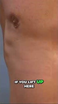 1 Month Post Op Gynecomastia Surgery By Dr. Lebowitz