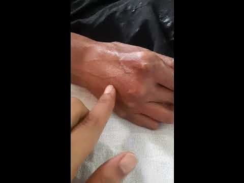 Systemic sclerosis Clinical Overview