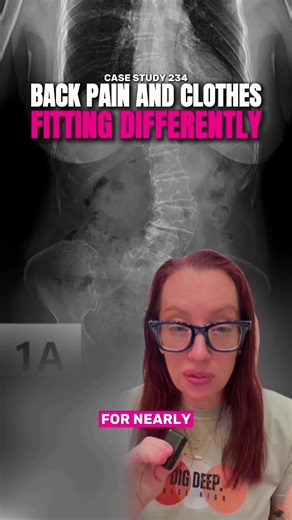 Case Study 234 | The forest vs the tree Not every spine problem is found on an MRI. Sometimes the most important imaging study is the simplest one: a standing X-ray. When symptoms, posture, and function don’t match the MRI findings, it’s time to look at the spine under load. What diagnosis do you think we’re dealing with here? I’ll explain tomorrow! #casestudy234 #ladyspinedoc #sundaycasestudy