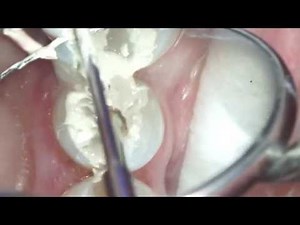 ROOT CANAL up close & personal!