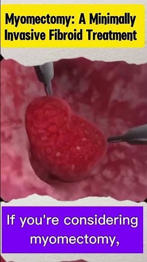 Myomectomy: A Minimally Invasive Fibroid Treatment
