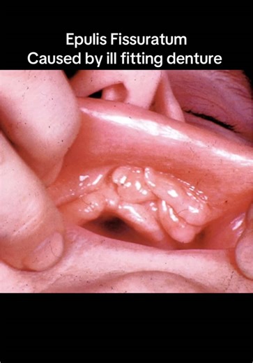 Understanding the Risks of Loose Ill-Fitting Dentures