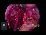 Endometriosis and Infertility Surgery • Video • MEDtube.net