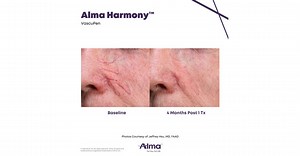 Alma Unveils Alma Harmony™ and Alma IQ™ in U.S. Market, Advancing Personalization in Aesthetic Treatments