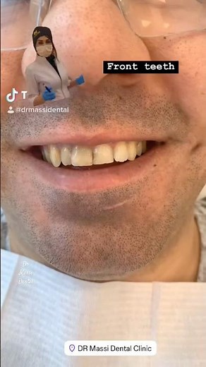 CROWNING FRONT TEETH 🦷👑