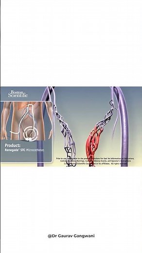 Non-surgical treatment of Varicocele (3D animation) | Varicocele embolization | by Dr. Gaurav G.