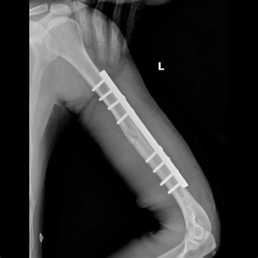 Humerus fracture fixation || common arm injury || Early mobility after humerus fracture surgery.