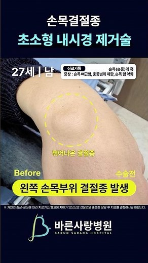 손목에 볼록한 혹, 손목결절종 내시경수술 27세(남성) 환자분의 치료사례 | 바른사랑병원 정형외과 전문의 문홍교 대표원장 #손목통증 #손목결절종 #ganglioncyst