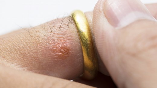 Mayo Clinic Minute: Wedding ring rash - Mayo Clinic News Network
