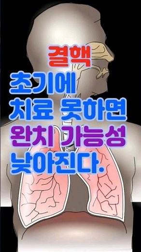 폐결핵 치료법 완치의 비결, 알고보면 간단👍 폐결핵 증상 결핵 진단 예방법 결핵전염 기침 결핵재활 백신 폐병 금연