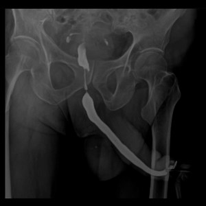 Retrograde Urethrography 2