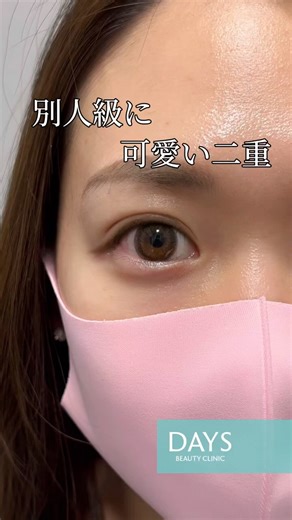 【目周り整形】別人級に可愛い二重つくります#shorts
