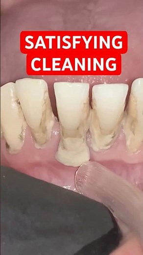 The Most Satisfying Dental Cleaning You’ll See Today ✨🦷