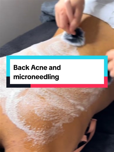 Acne treatment for the back #mauritius🇲🇺 #fyp #viralvideos #acneproneskin #microneedling