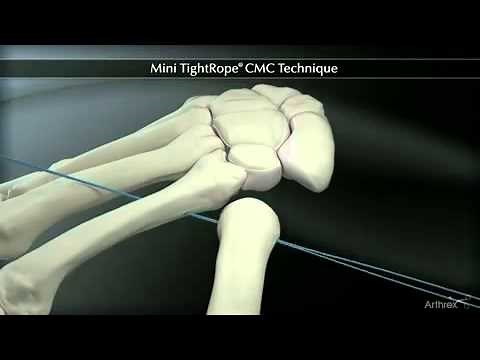 Mini TightRope CMC Technique