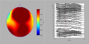 16 reactions | [Epilepsy] Kokkinos et al.: "Understanding the focal features in childhood absence epilepsy avoids misdiagnosis as focal epilepsy and inappropriate treatment." https://doi.org/10.1016/j.clinph.2017.05.021 | IFCN and its Clinical Neurophysiology journals | Facebook