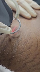 758 reactions · 16 shares | Fade Stretch Marks with Advanced Laser...