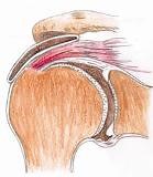 Arthroscopic Acromioplasty, Orthosports Orthopaedic Surgeons