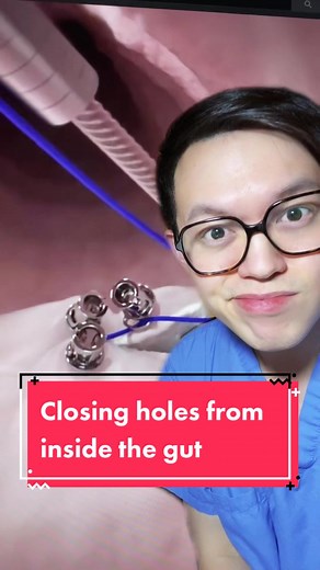 Closing holes from inside the gut 😱 #suturing #gastroenterology