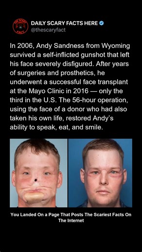 Thescaryfact ™ on Instagram: "In 2006, Andy Sandness attempted to take his own life but survived the gunshot, leaving his face destroyed beyond recognition. For ten years, he lived in the shadows, enduring countless surgeries and prosthetics that could never bring back what he’d lost. Then, in 2016, surgeons at the Mayo Clinic performed a 56-hour face transplant — one of the first in the U.S. His donor, a man who had also taken his own life, gave Andy the gift of a second chance. When Andy looke