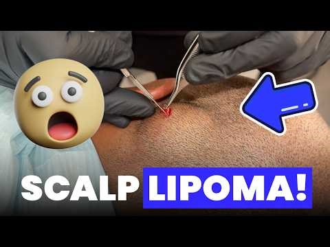 SCALP LIPOMA!