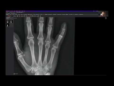 Hand X-Ray Case Review: Detecting a Little Finger PIP Joint Dislocation