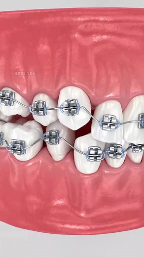 1.2K views | Abnormal Teeth Position and Its Correction with Braces #teethalignment #bracestreatment #orthodontics #DentalCare #toothalignment | PurelyFit | Facebook