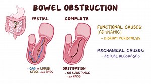 Video: Bowel obstruction: Clinical - Video Explanation! | Osmosis | Osmosis