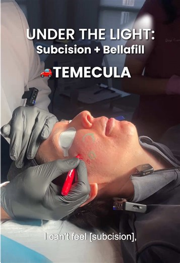 "I can’t feel it, but I could hear it." That sound is often the first ... | acne scar treatment